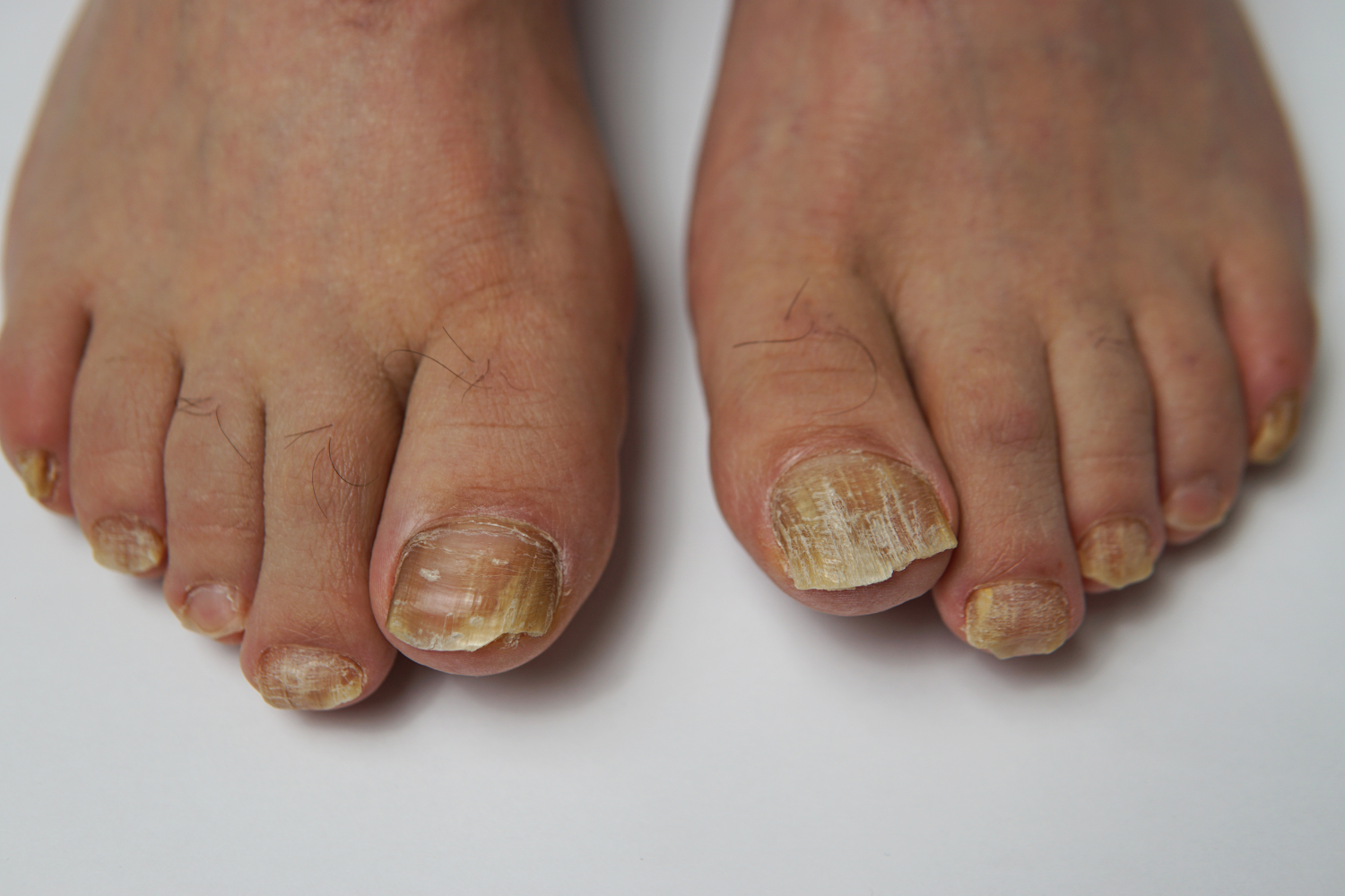 Feet fungus